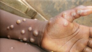 Read more about the article U.S. pledges $500 million, one million doses of vaccine to combat mpox in Africa