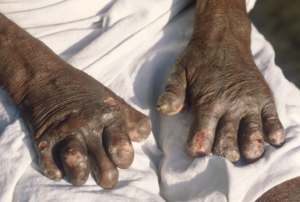 Read more about the article NAFDAC clarifies delay in importation of leprosy drugs